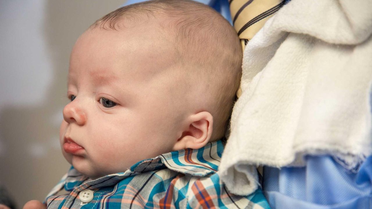 Reshaping baby's ears without surgery must start early Newsday