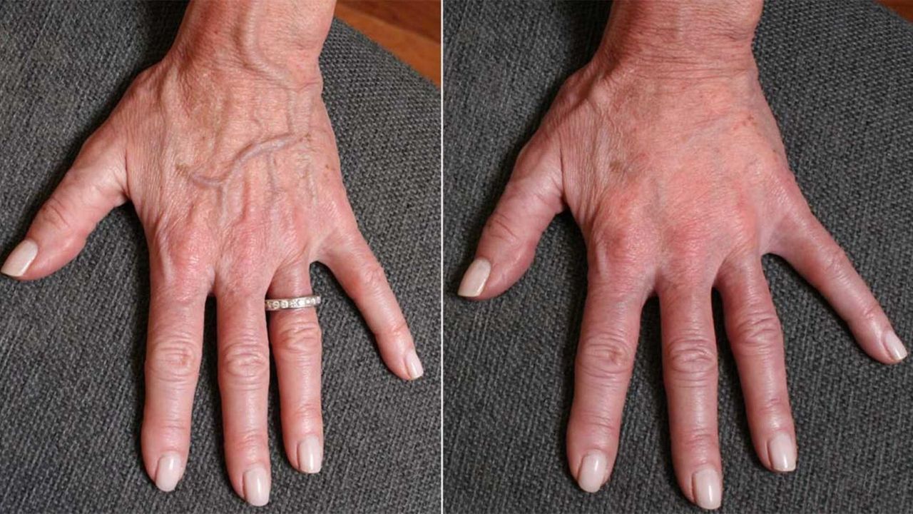 Oldlooking hands? Consider a handlift Newsday