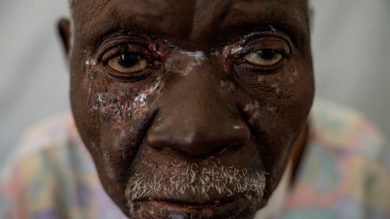 Christophe Chavilinga, 90, suffering from mpox, waits for treatment at...