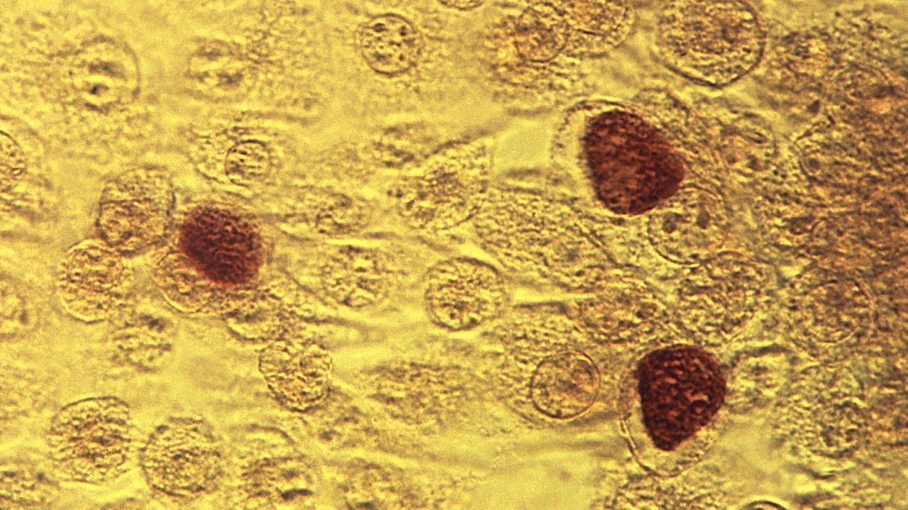 CDCによると、性感染症の流行は鈍化しているが、ニューヨーク州では依然として一部が増加傾向にあるとLIで発表