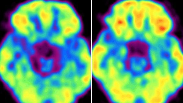 Photo of the brain with cell phone off, at left,...