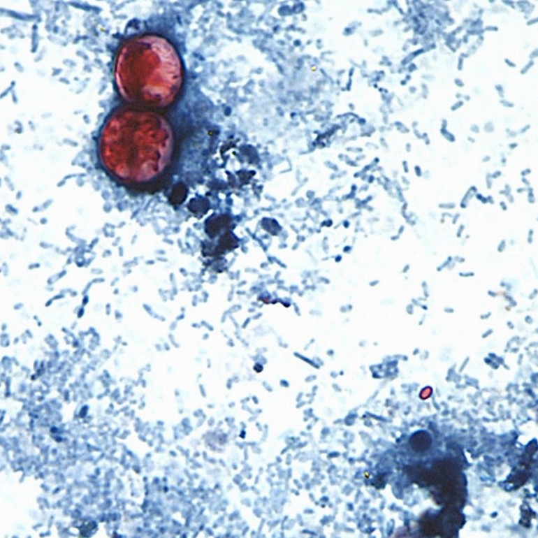 Cyclospora found at Mexican farm linked to lettuce outbreak, FDA says ...