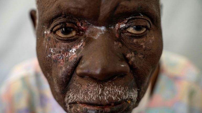 Christophe Chavilinga, suffering from mpox, waits for treatment at a...