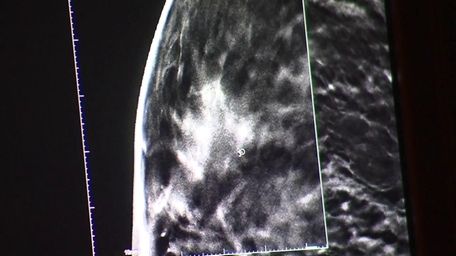 A file image of breast tissue seen in