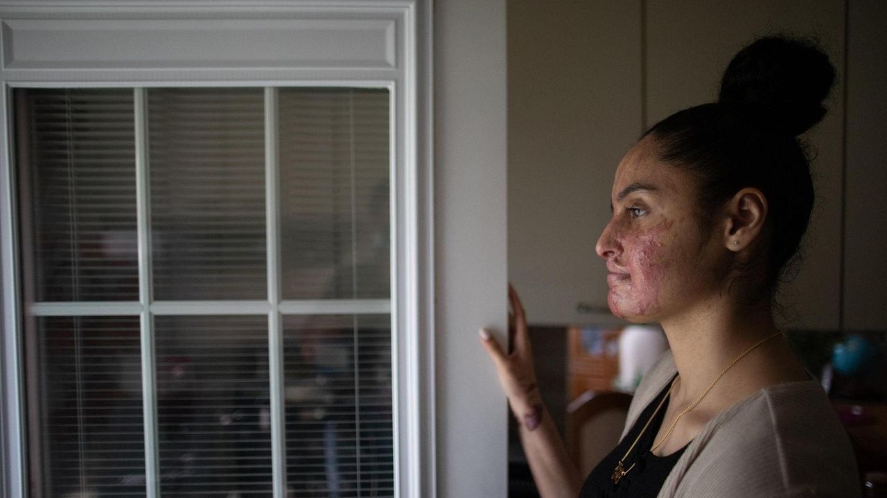 Elmont acid attack victim Nafiah Ikram on Wednesday